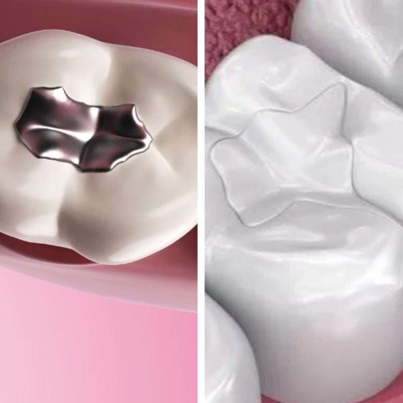Amalgam Fillings vs Composite Fillings - O'Hagan & Murray