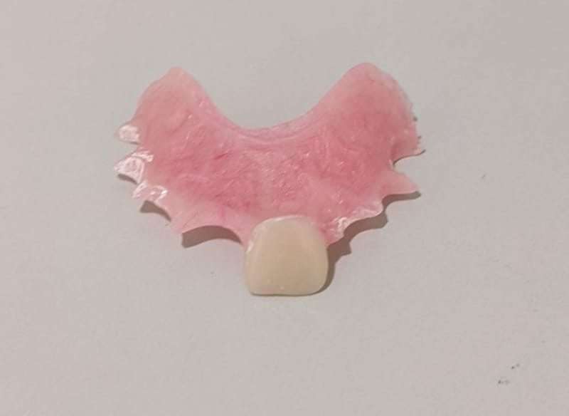 Single Tooth Dentures – Explore Partial Acrylic Dentures in Newry